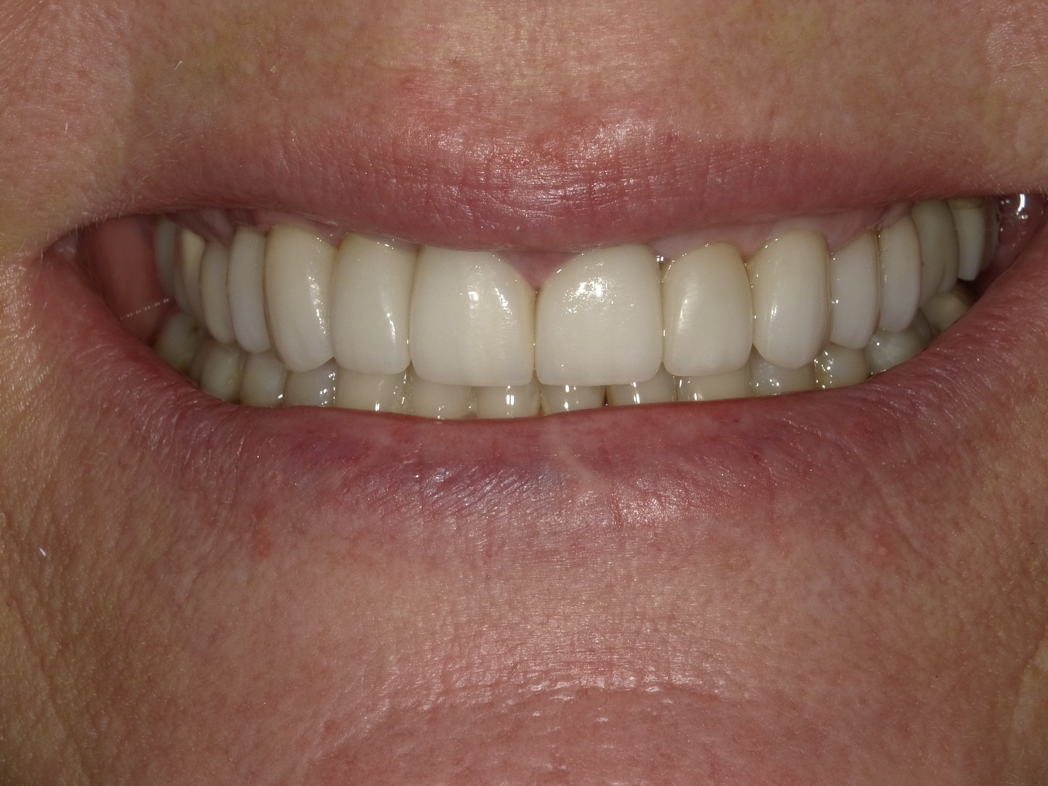 After smile transformation