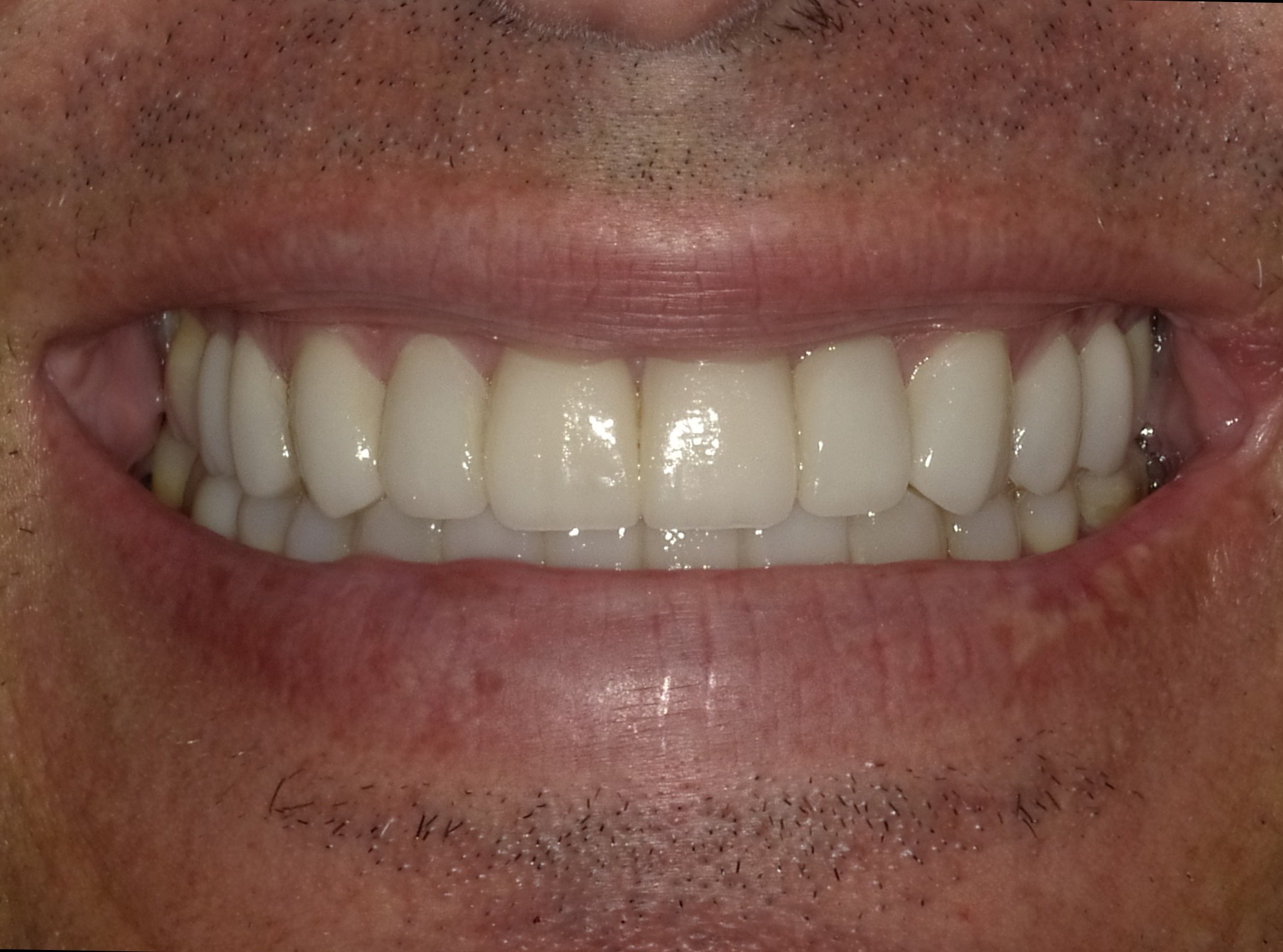 After smile transformation
