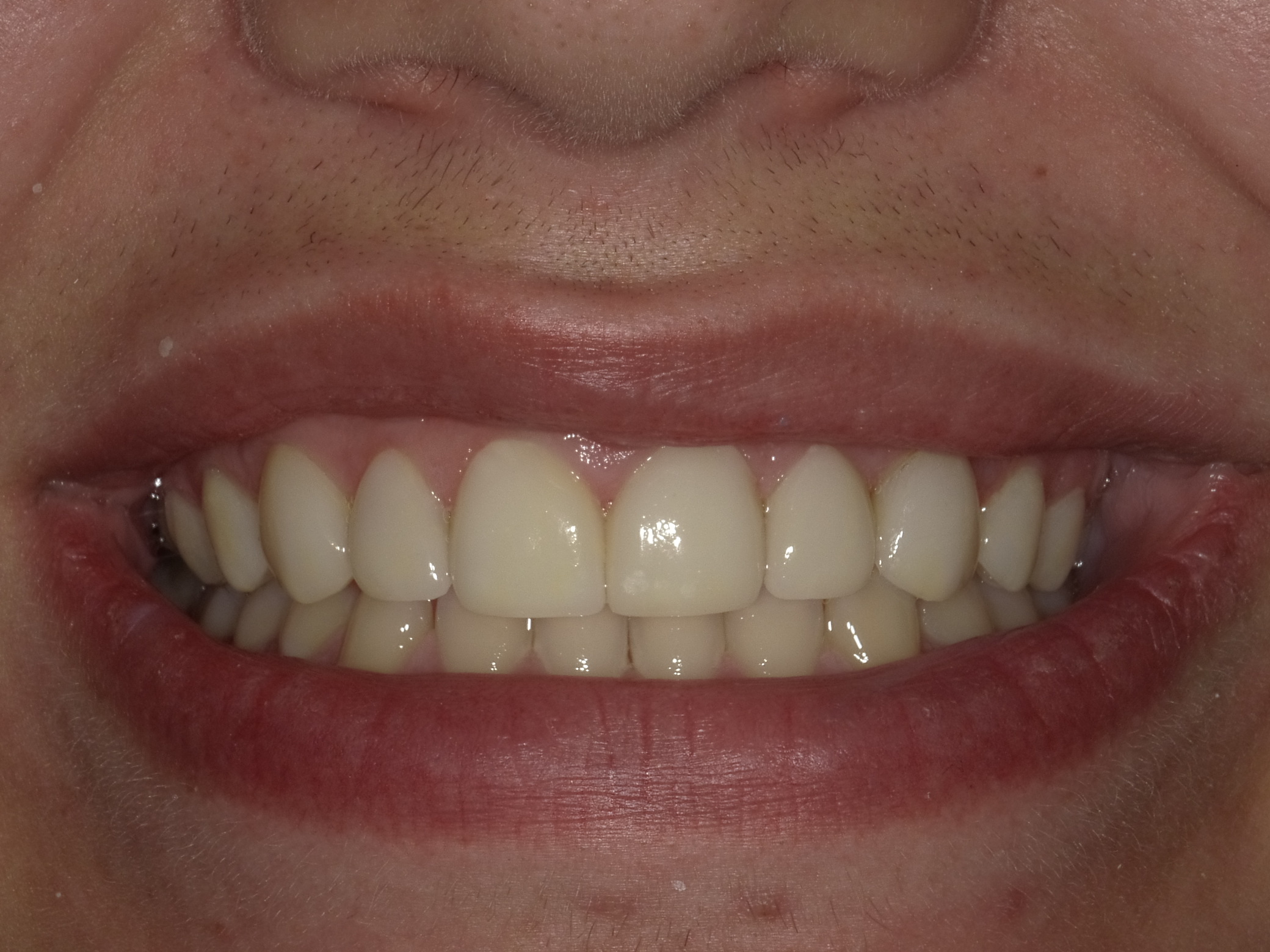 After smile transformation
