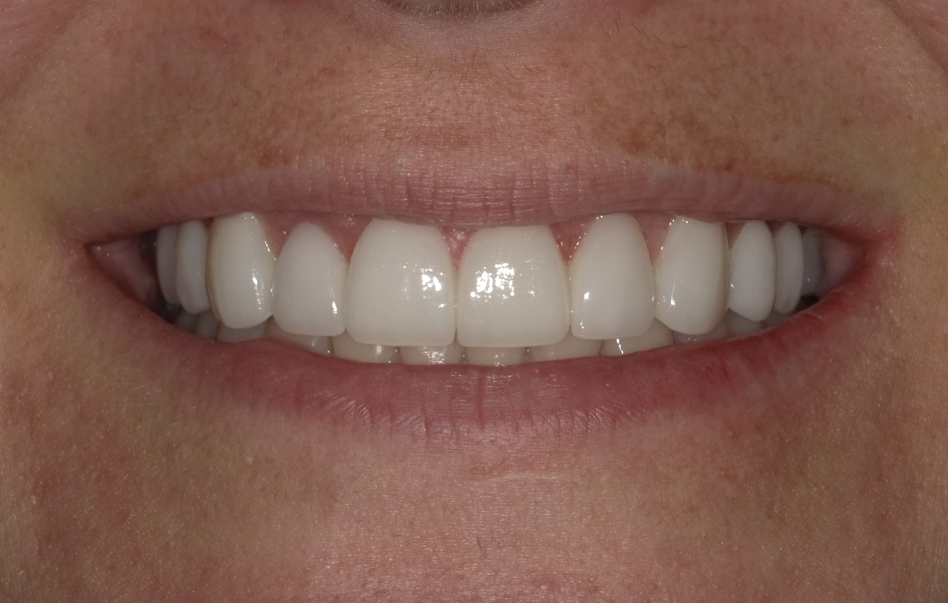 After smile transformation