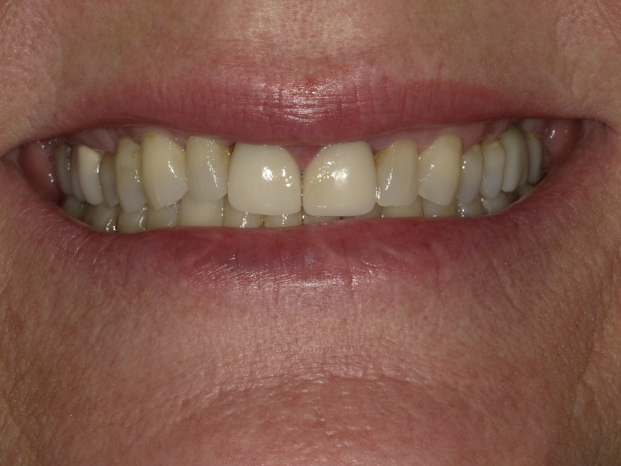 Before smile transformation