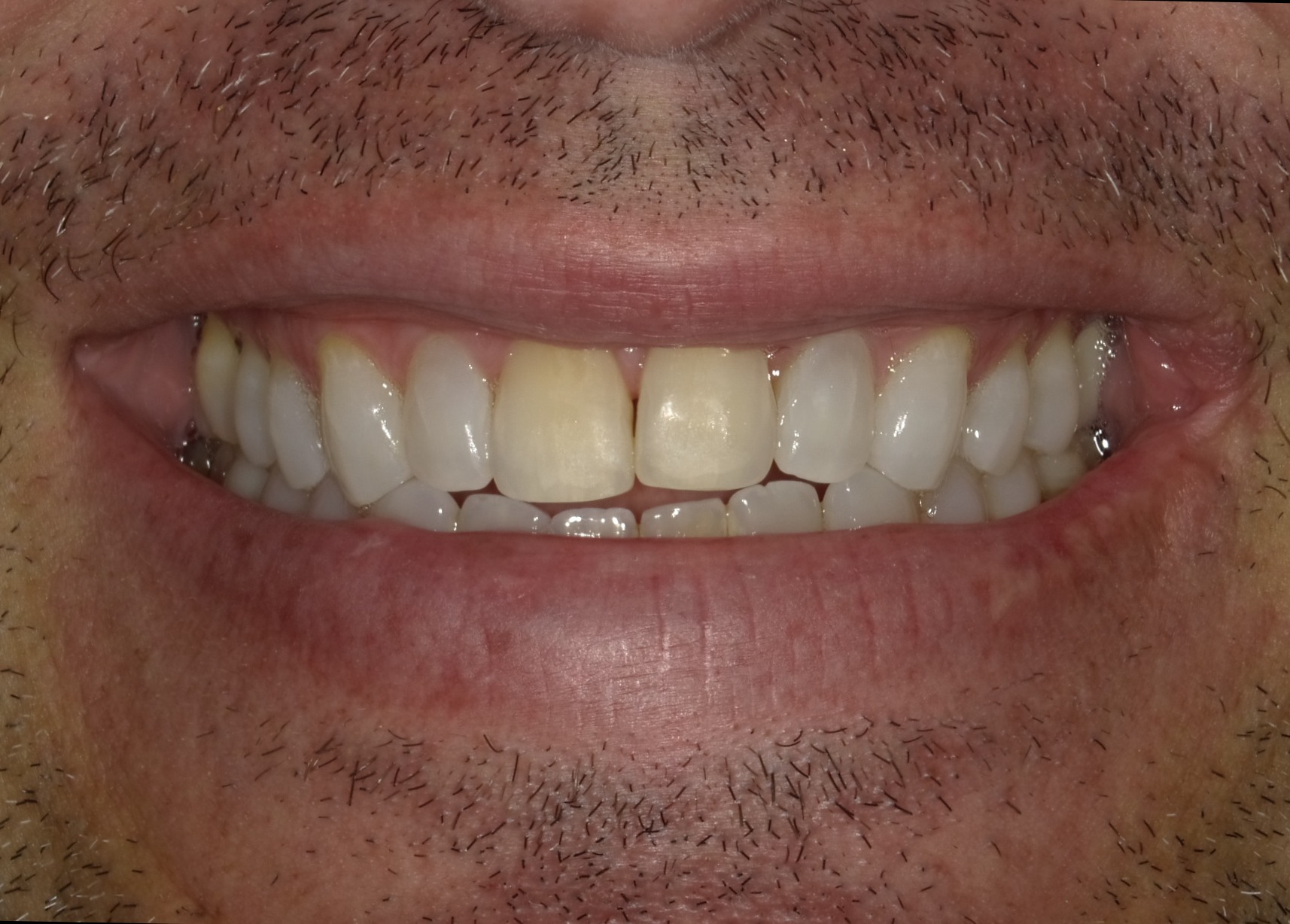 Before smile transformation