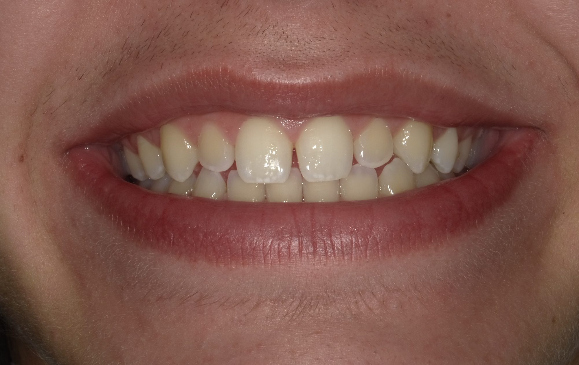 Before smile transformation