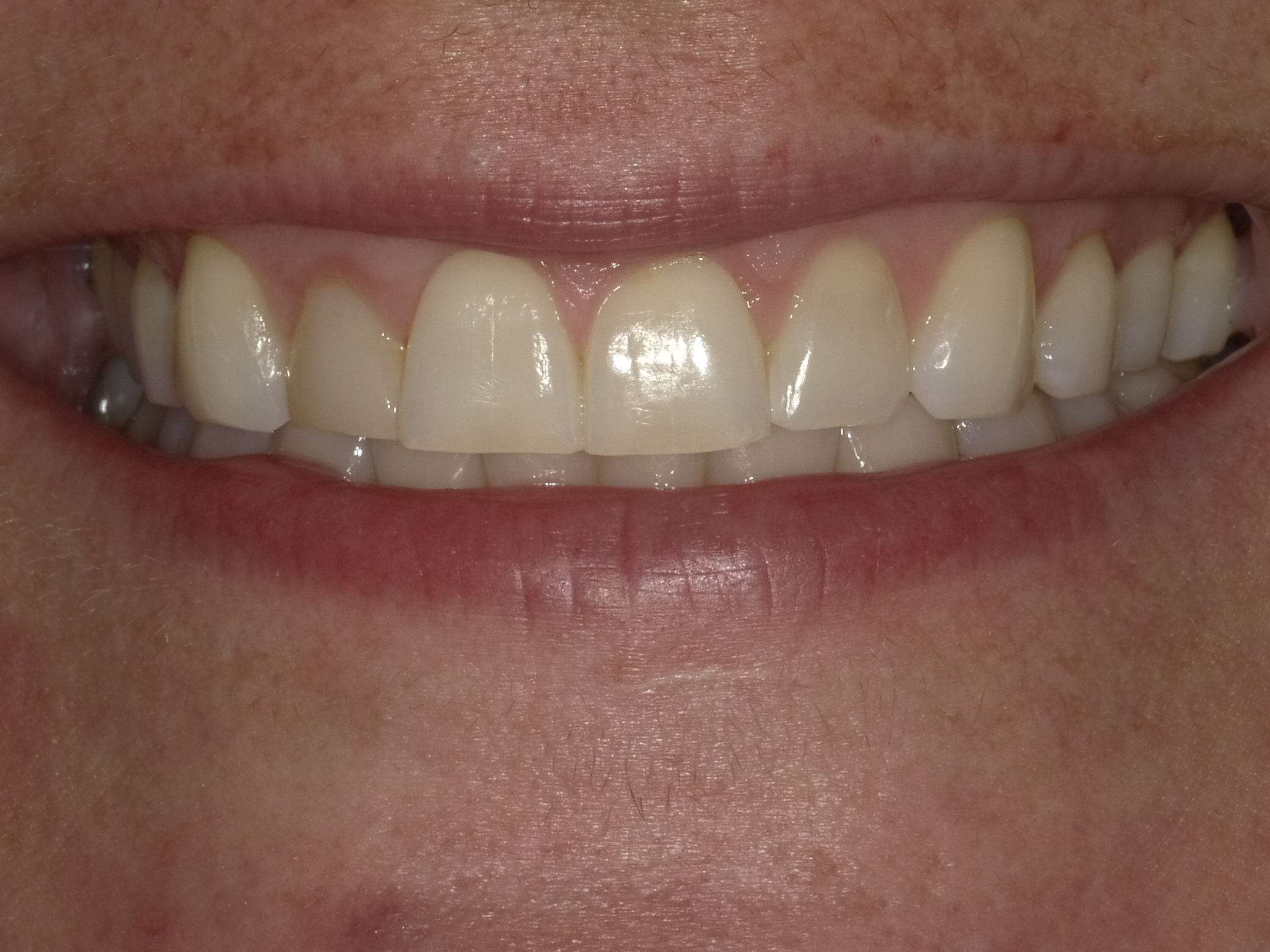 Before smile transformation